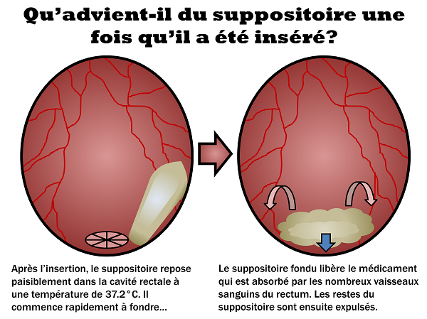 comment mettre un suppositoire